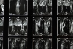 Spinal cord accident claim